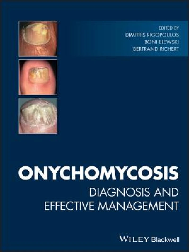 Onychomycosis