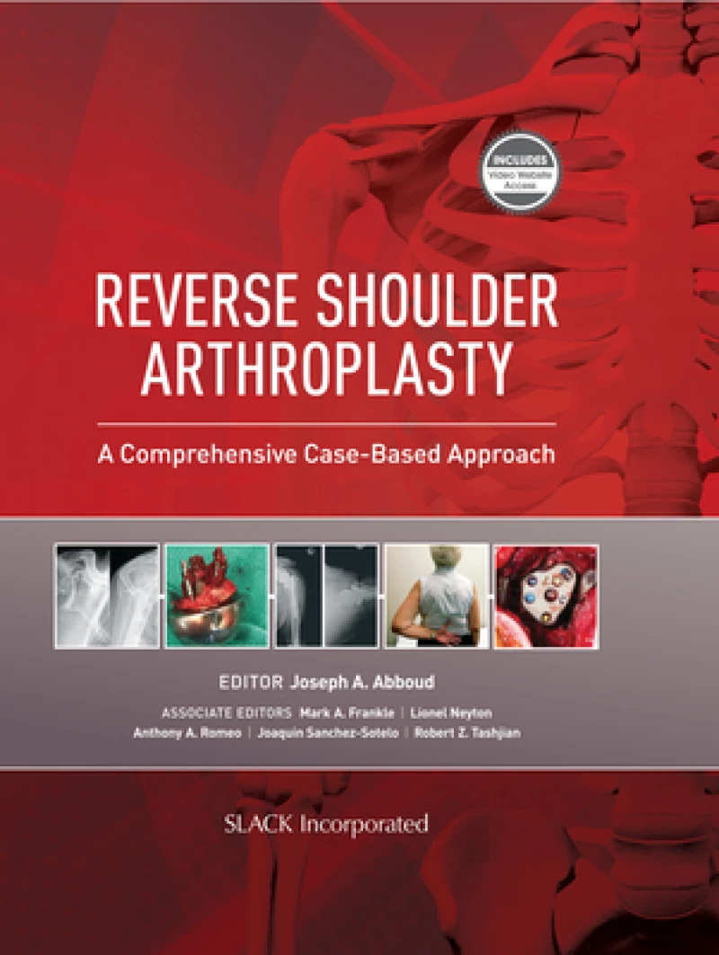 Reverse Shoulder Arthroplasty