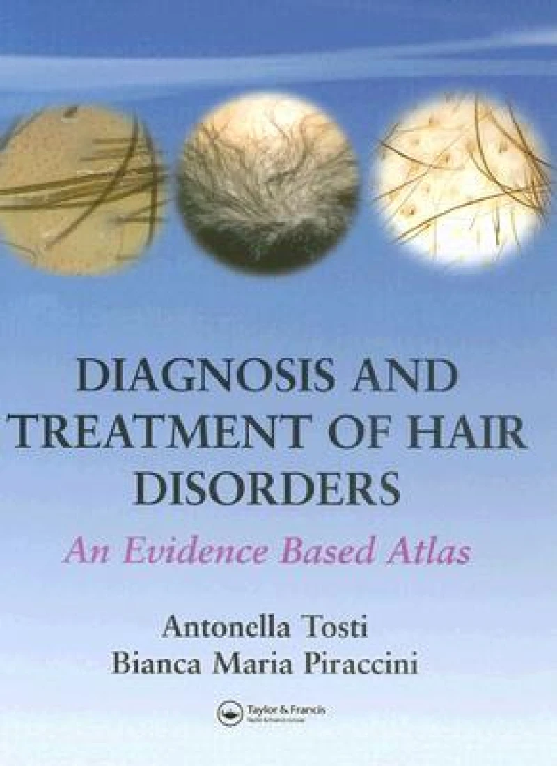 Diagnosis and Treatment of Hair Disorders
